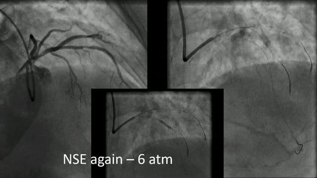 Simplify PCI! Know where and how to win with drug-coated balloon