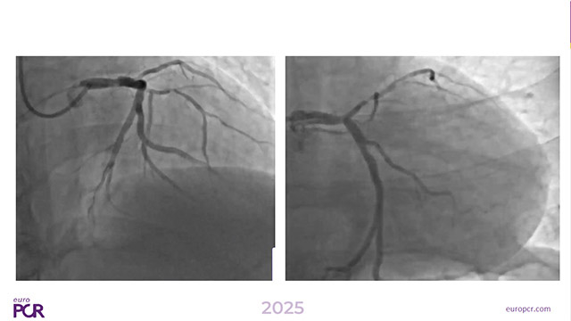 STEMI - What if a culprit lesion is not identifiable?