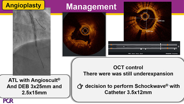 Stent failure: don't guess, just see!