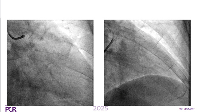 Strategic decision in stent failure