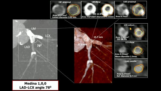 Supraflex for high-risk patients and lesions: from practice to evidence-based medicine proven through FIRE and COMPARE
