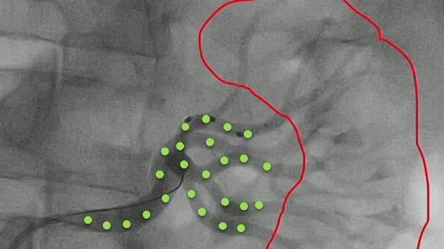 Symplicity Spyral renal denervation: more insights from clinical practice