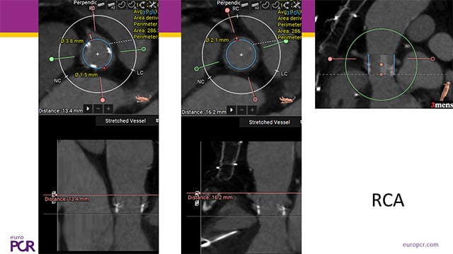 TAV-in-TAV complications
