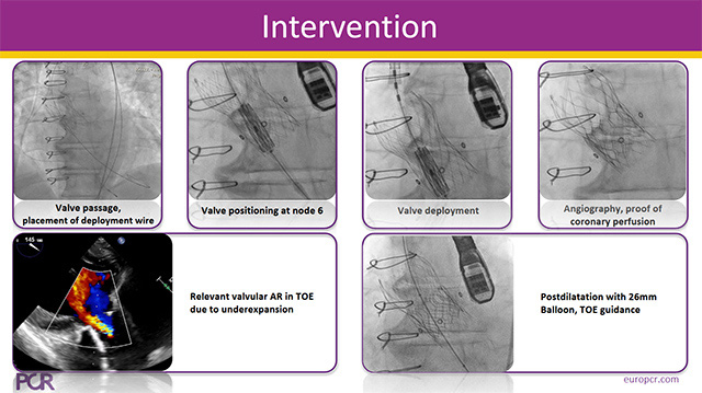 TAV-in-TAV in SAV 3 valves procedures