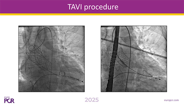 TAVI coronary access