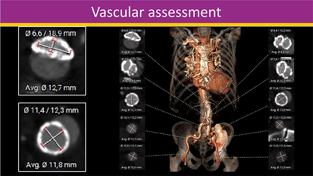 TAVI for aortic regurgitation: on-label and off-label use