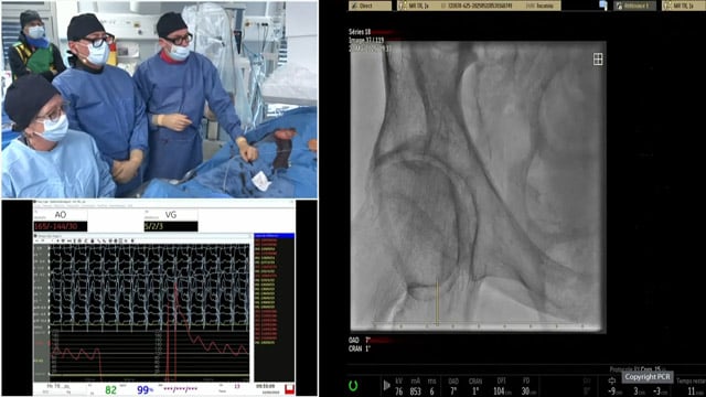 TAVI for bioprosthetic valve failure - LIVE Case