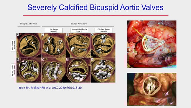 TAVI in bicuspid: all you need to know