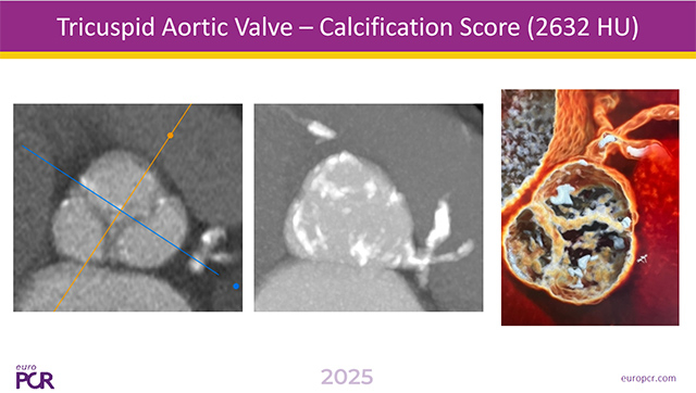 TAVI in challenging cases: pushing the limits