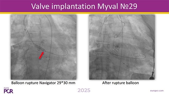 TAVI - Procedural complications