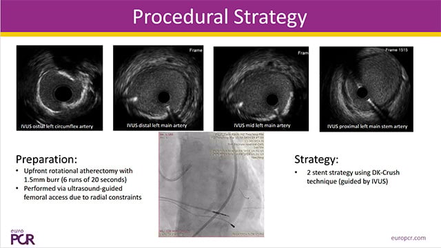 Techniques and decision making in management of coronary bifurcation lesion
