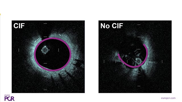The rise of intracoronary imaging: current use and new tools