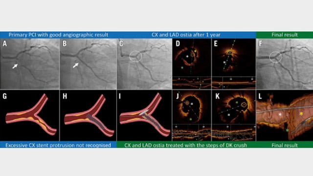 Through decisions in complex left main PCI - Isolated ostial left circumflex
