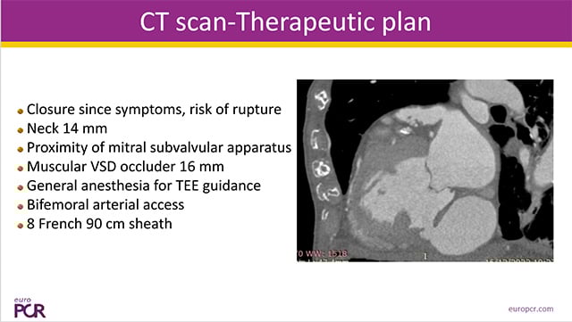 Transcatheter management of structural defects