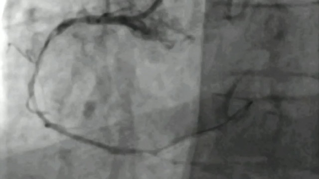 Treating complex CAD indications with sirolimus coated balloon: evidence and performance