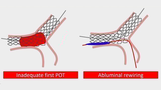Two-stent techniques for non-left main true bifurcation lesions