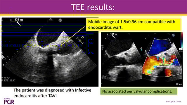 Unusual STEMI presentations: coronary embolism