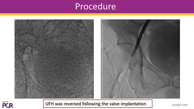 What did we learn from my TAVI complications?
