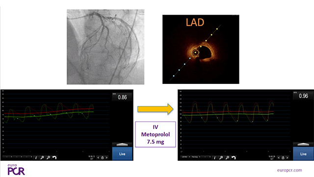 When coronary angiography is not enough