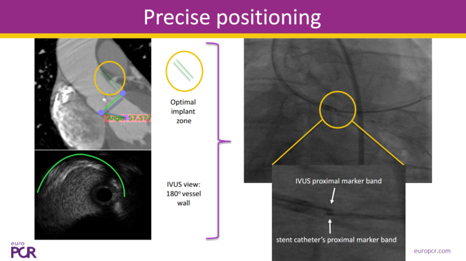 Which techniques for the treatment of left main lesions ?