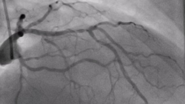 Calcified lesions: LIVE Educational Case from King Faisal Cardiac Center, National Guard Health Affairs- Western region - Jeddah, Saudi Arabia