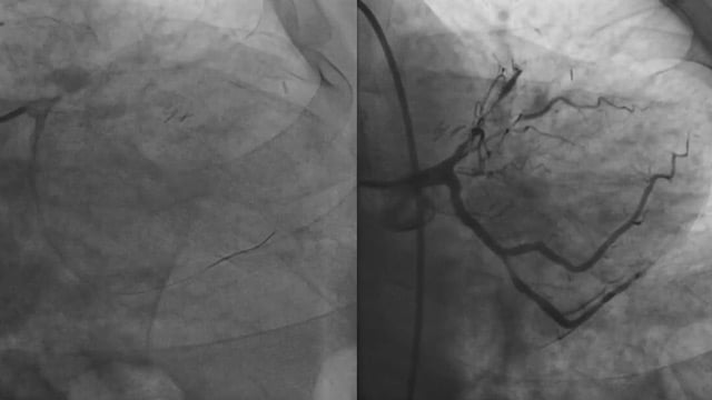 Challenging PCI scenarios after CABG