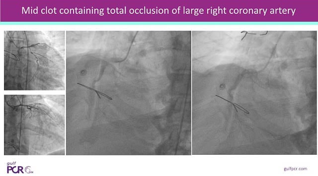 Challenging STEMI scenarios - Part 1