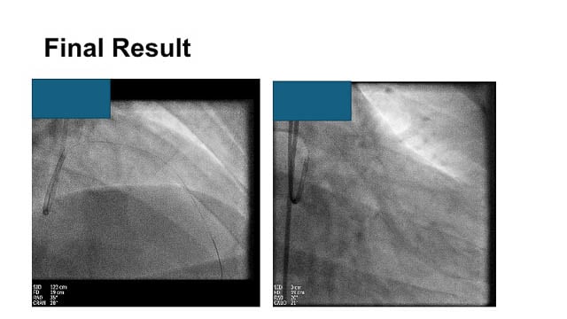 Challenging STEMI scenarios - Part 2