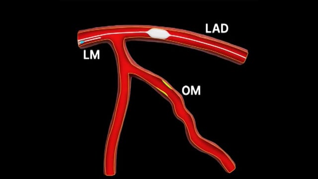 Complication session