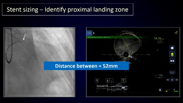 Cracking calcium in modern PCI