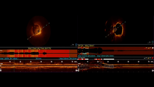 Global momentum of Shockwave intravascular lithotripsy: evidence, experience and evolution