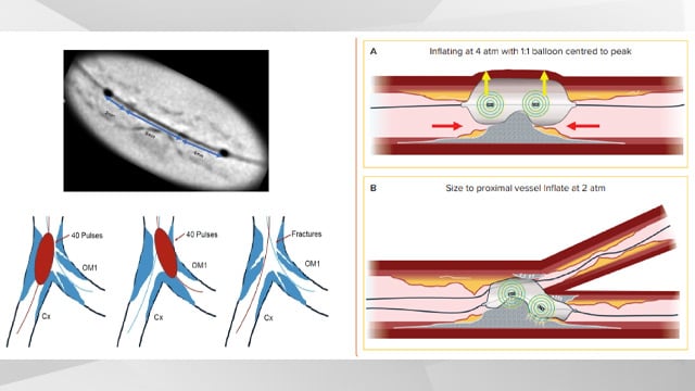 Global momentum of Shockwave intravascular lithotripsy: evidence, experience and evolution