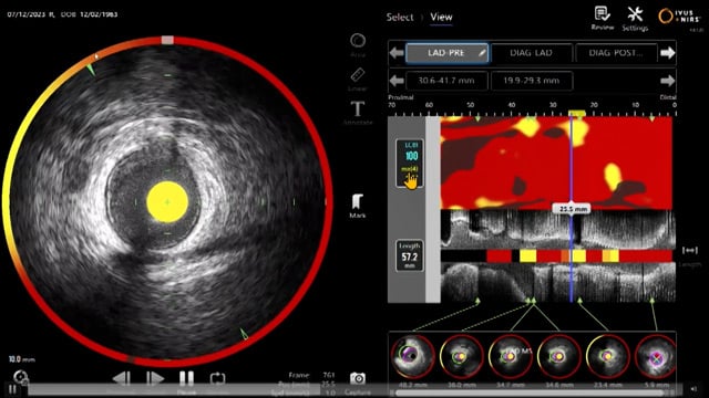 NIRS-guided PCI: beyond calcium to precision PCI