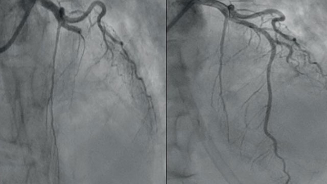Occlusion myocardial infarction