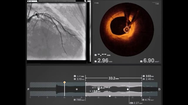 Precision without a scaffold - When, why and how to use DCB in de novo lesions