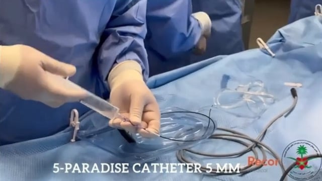 Renal denervation today and tomorrow