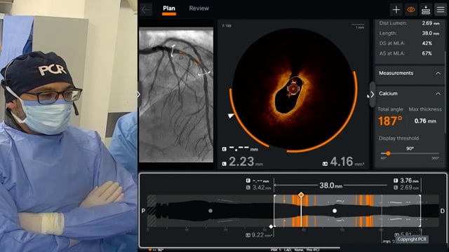 Seeing is believing: OCT-guided calcium modification in complex PCI