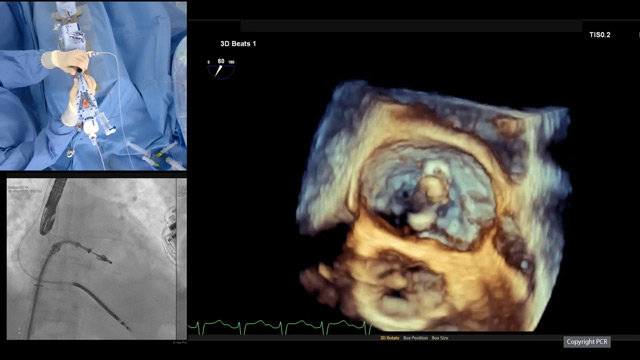 Mitral transcatheter edge-to-edge repair - LIVE Case