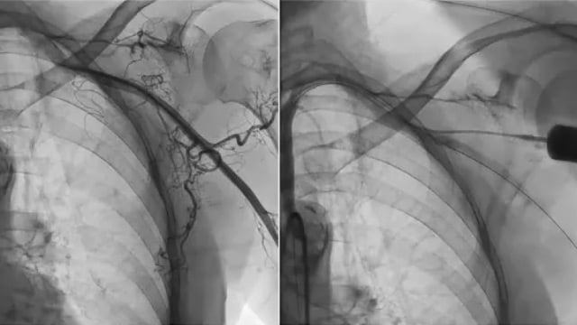 Redefining standards: TAVI in the era of lifetime management, beyond high-risk patients