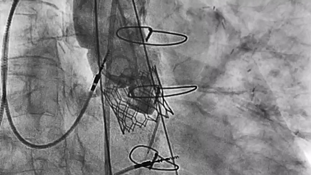 Second valves strategies with SAPIEN 3 Ultra RESILIA - Regional insights