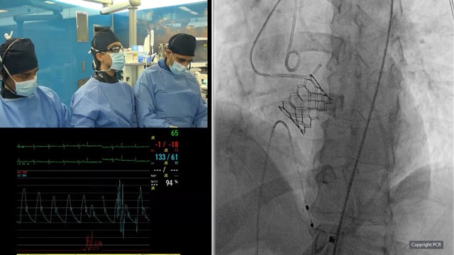 TAVI for mixed aortic valve disease - LIVE Case
