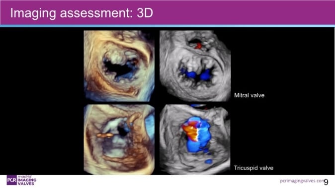 Advancing transcatheter solutions for tricuspid valve disease