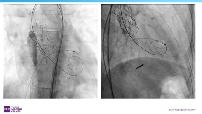 Navigating complexities in multivalvular heart disease