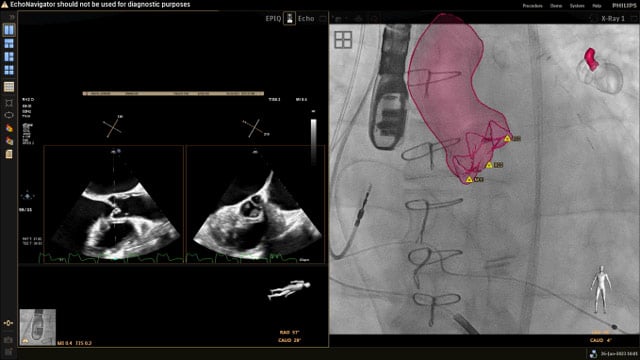 Taking the next step in the evolution of aortic regurgitation treatment
