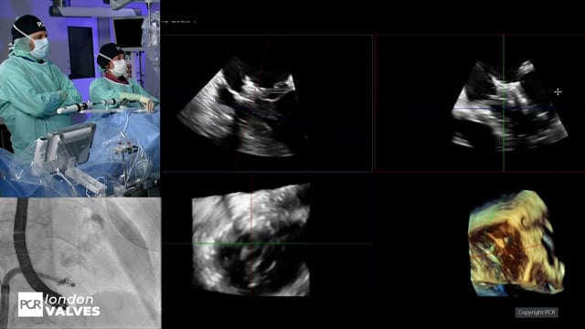 Advancing structural heart with 3D ICE and device guidance