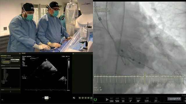 Align for the future with next gen Myval transcatheter heart valve series