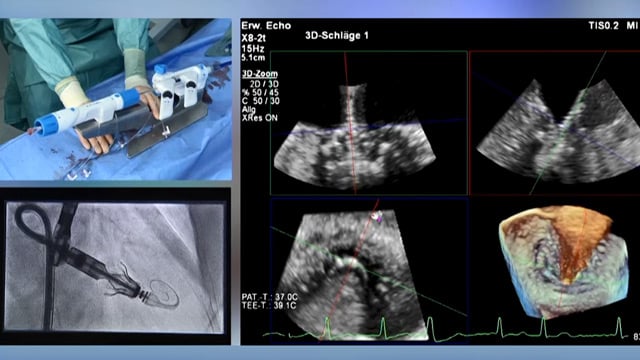 Cardiovalve hits the TARGET: advancing transcatheter valve replacement