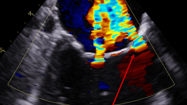 Challenging mitral TEER: overcoming access limitations and anatomical challenges