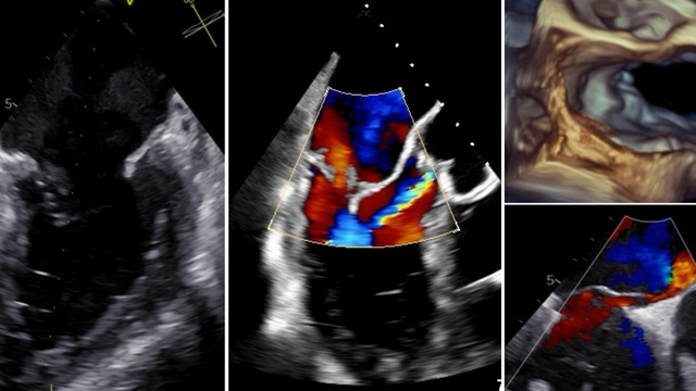 Challenging mitral TEER: Barlow's disease, fibro-elastic deficiency & abnormal valve morphology