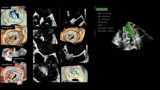 Complications and bailout strategies in transcatheter mitral edge-to-edge repair